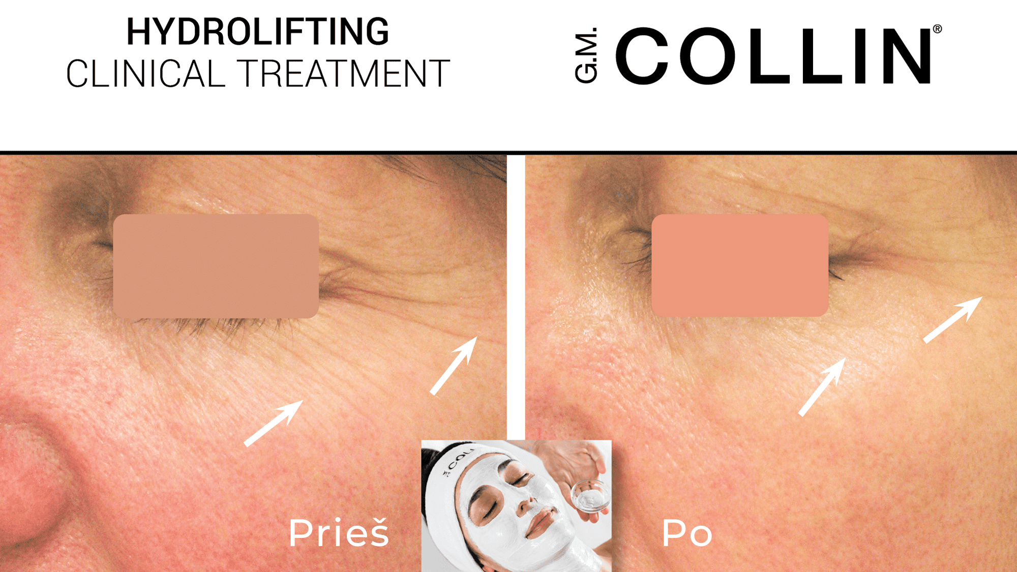 2-Hydrafacial-procedura-pries-po-1-maani